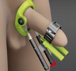 Penisi arttırmak için bir operasyondan sonra rehabilitasyon