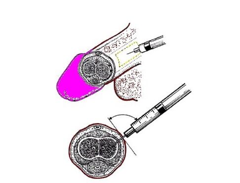 Arttırmanın bir yolu olarak petrol jölesini penise pompalamak
